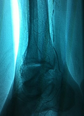 Before Restoration of Blood Flow