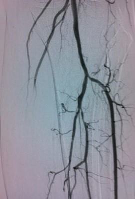 Left Popliteal artery open after intervention